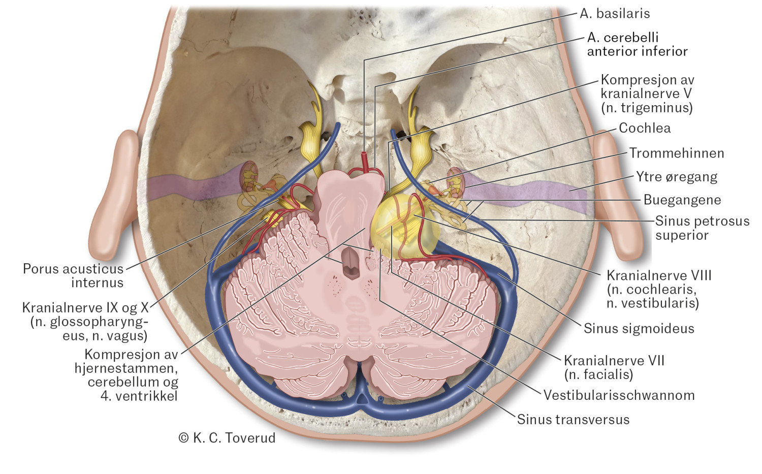 Figur 1 Vestibularisschwannom og omliggende anatomi.