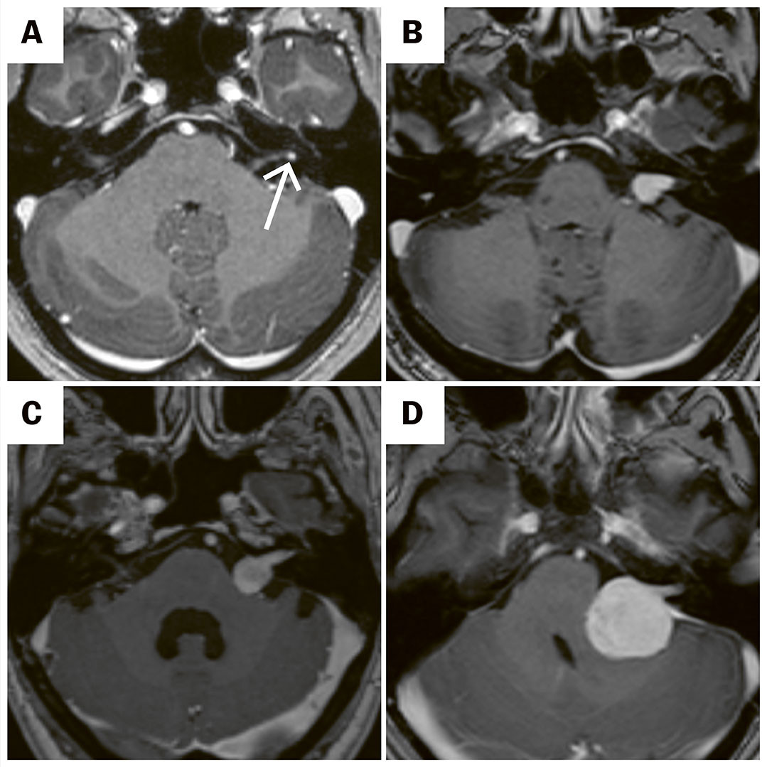 Figur 2 Typisk radiologisk presentasjon av vestibularisschwannom ved T1-vektet MR etter intraven&oslash;s kontrast. Her ses Koos'&hellip;