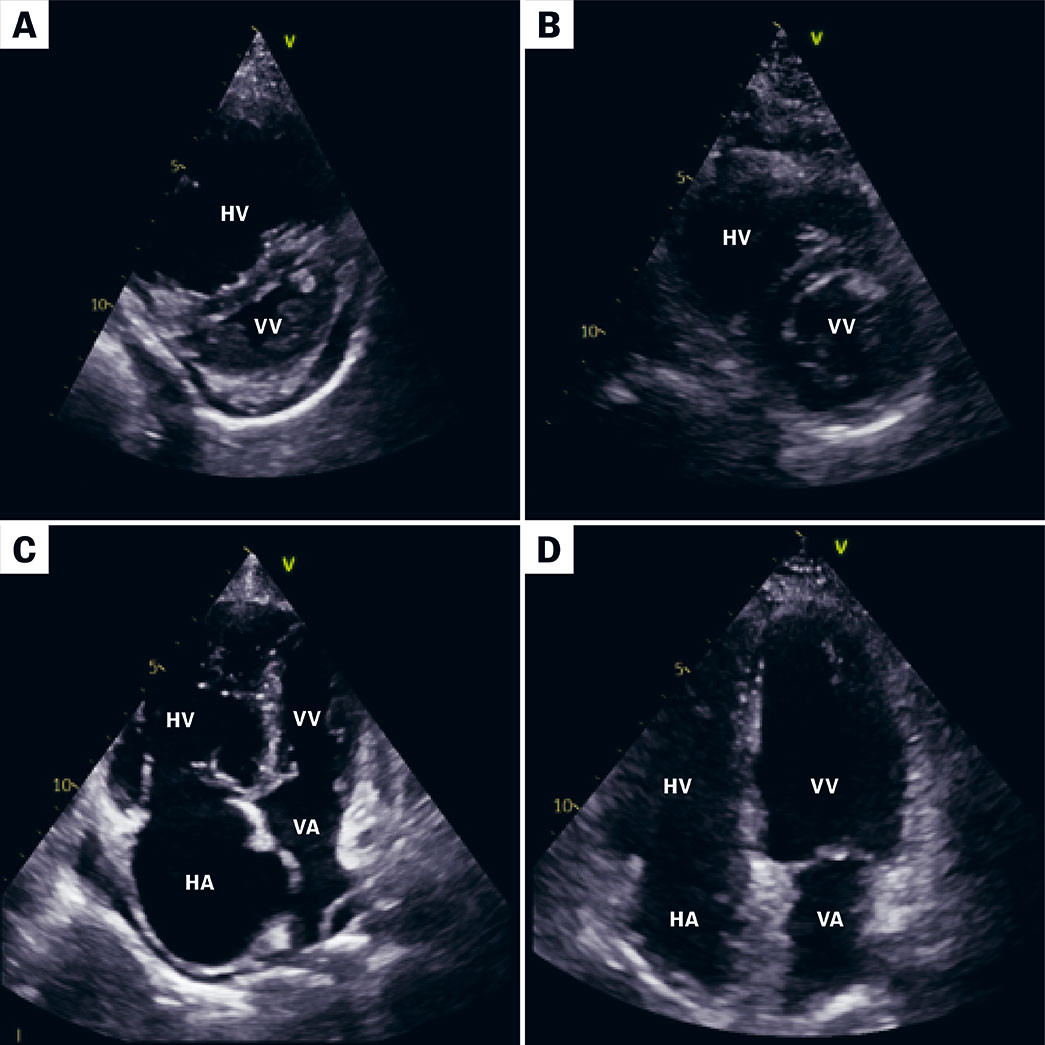 Figur 1 Panel A og B viser ekkokardiografi fra parasternal kortakse f&oslash;r og etter pulmonal endarterektomi. F&oslash;r kirurgi (A)&hellip;