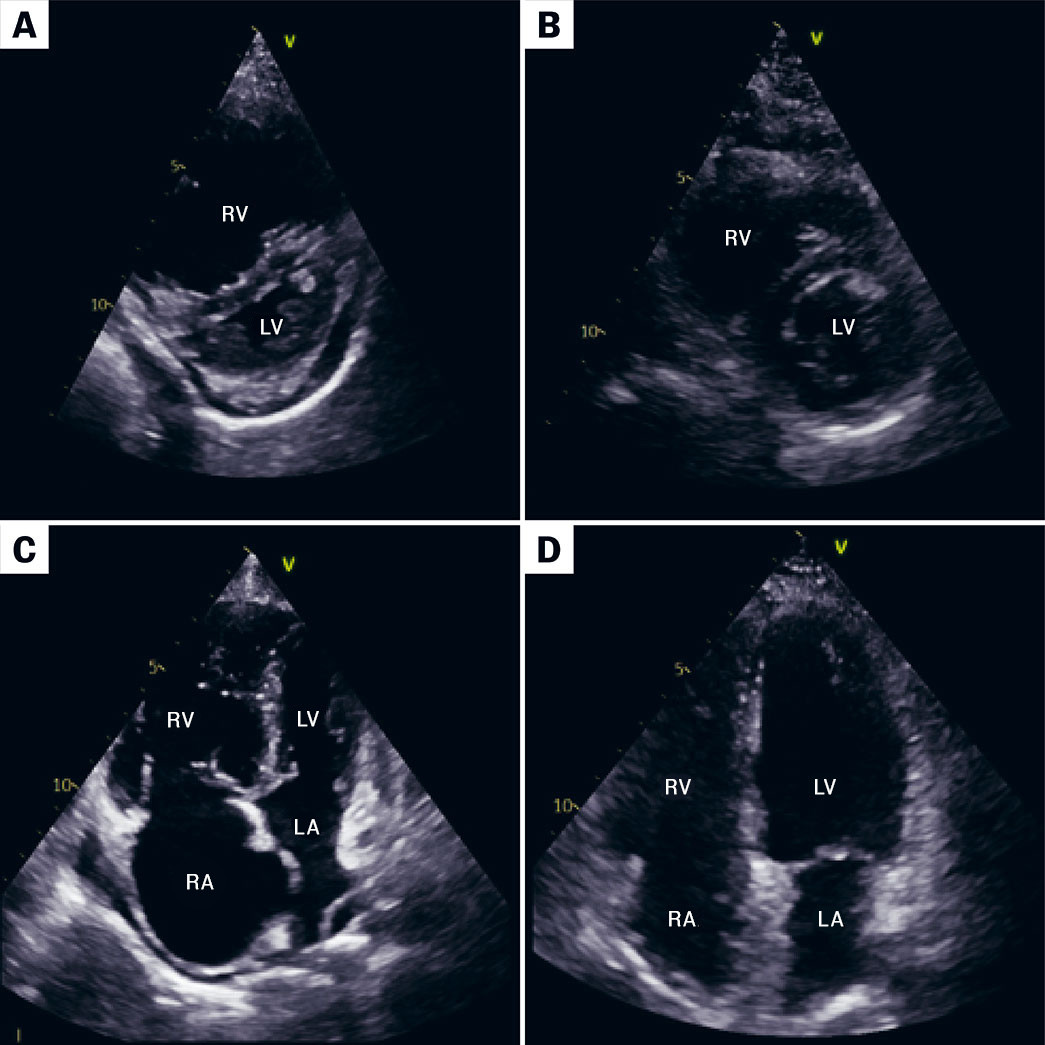 Figure 1 Panels A and B show echocardiography from the parasternal short axis view before and after pulmonary endarterectomy&hellip;