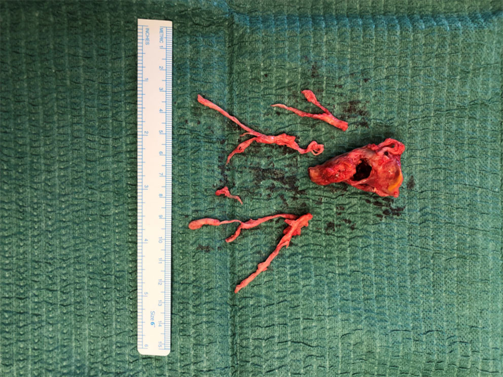 Figur 2 Intraoperativt bilde av tromboembolisk materiale fra h&oslash;yre lunge etter pulmonal endarterektomi.