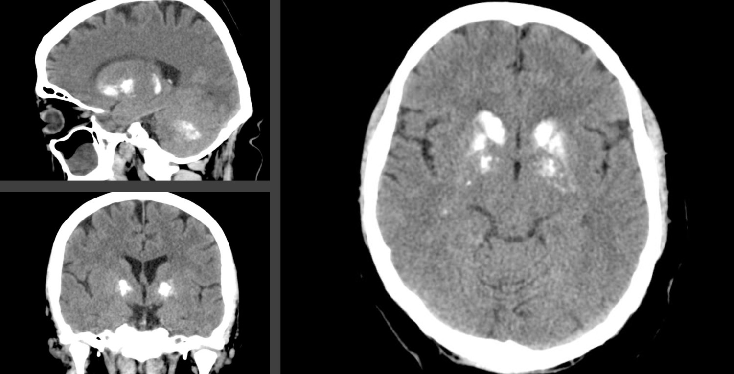 Figur 1 Utvalgte snitt fra 3D-computertomografi av hodet og hjernen til en person diagnostisert med Fahrs sykdom/prim&aelig;r&hellip;
