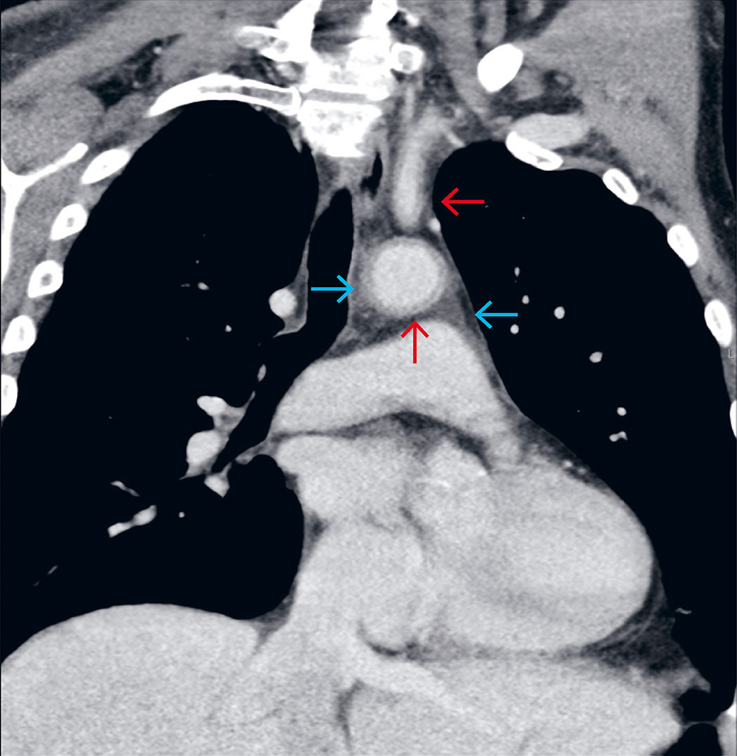 Figure 1 Computed tomography (CT) in the portal venous phase showed uniform wall thickening in the aorta and proximal branch&hellip;