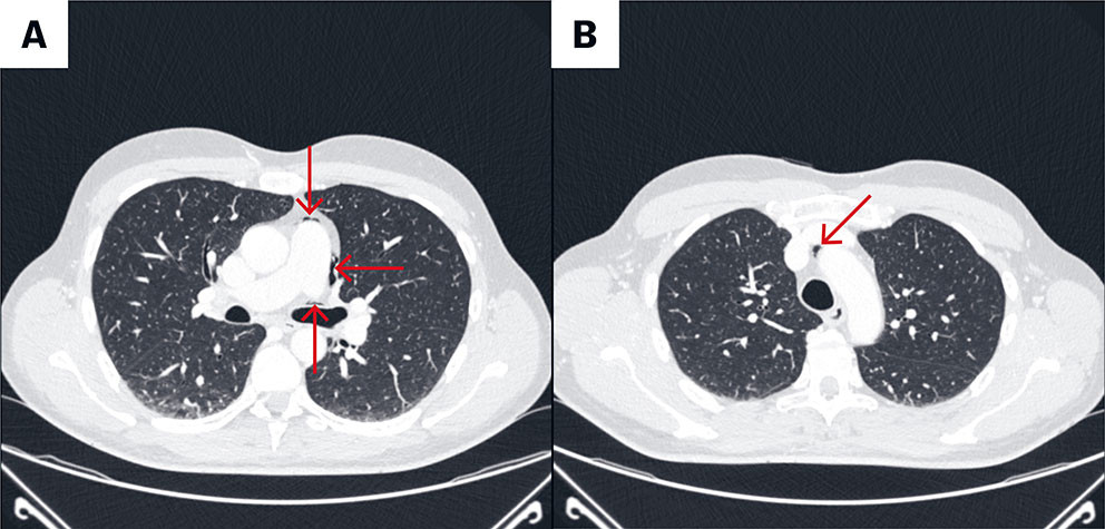 Figur 1 CT toraks med intraven&oslash;s kontrast i lungevindu viste gass i mediastinum (a) foran venstre hovedbronkus og mot&hellip;
