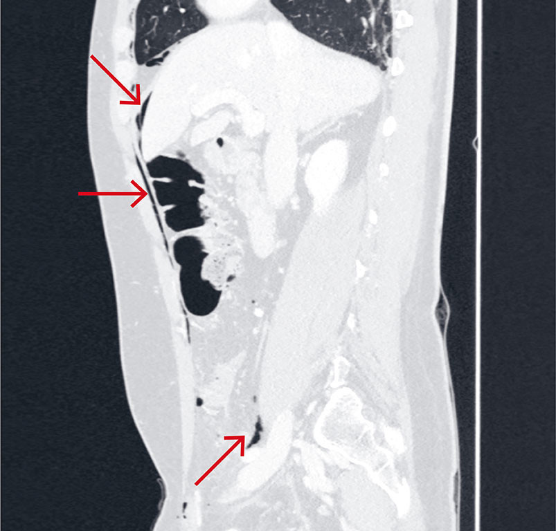 Figur 2 CT abdomen (sagittal reformatering) med intraven&oslash;s kontrast i lungevindu viste postoperative forandringer i venstre&hellip;
