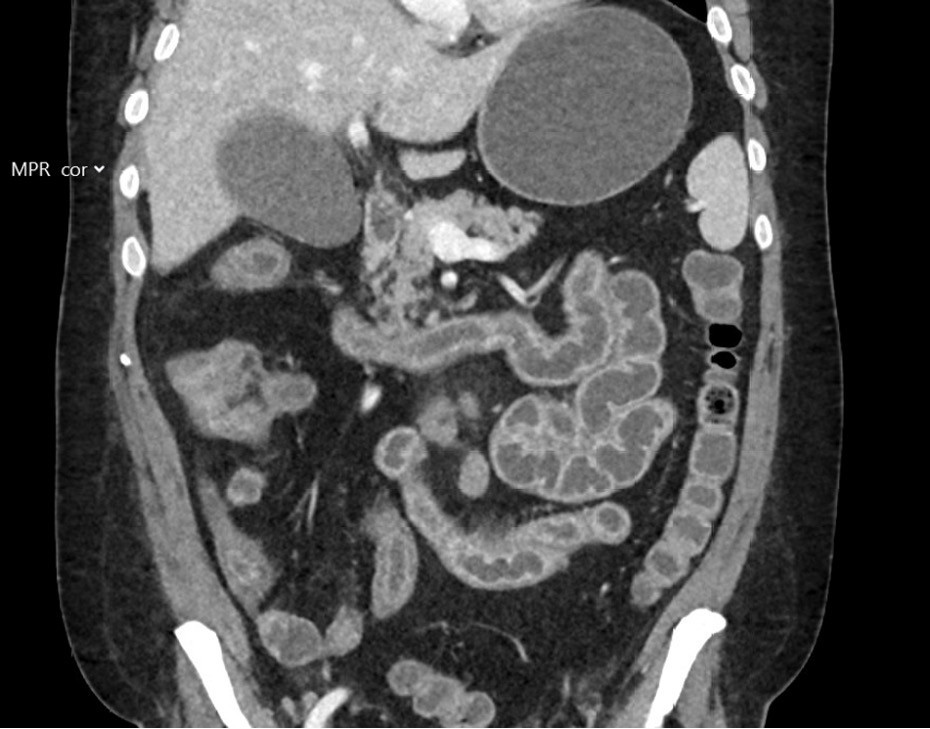 Figur 2 CT abdomen/bekken med intraven&oslash;s kontrast viser inflammasjon av tynntarm.