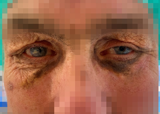Figure 1 Dark brown plaques under the eyes in necrobiotic xanthogranuloma.