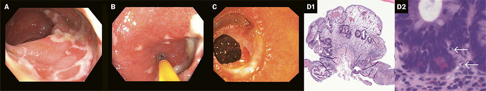Figure 3 a) shows fibrin-covered lesions in the colon; b) shows inflammation in the terminal ileum; c) shows patchy erythema&hellip;