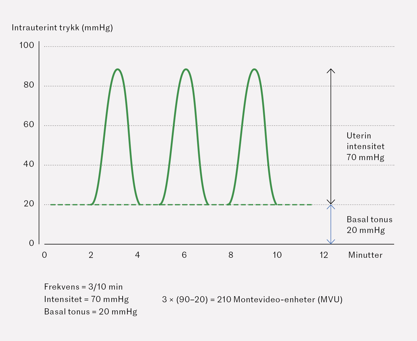Figur 2 Montevideo-enheter (MVU) er en standardm&aring;ling for livmoraktivitet under f&oslash;dsel, der en verdi p&aring; 200 MVU regnes som&hellip;