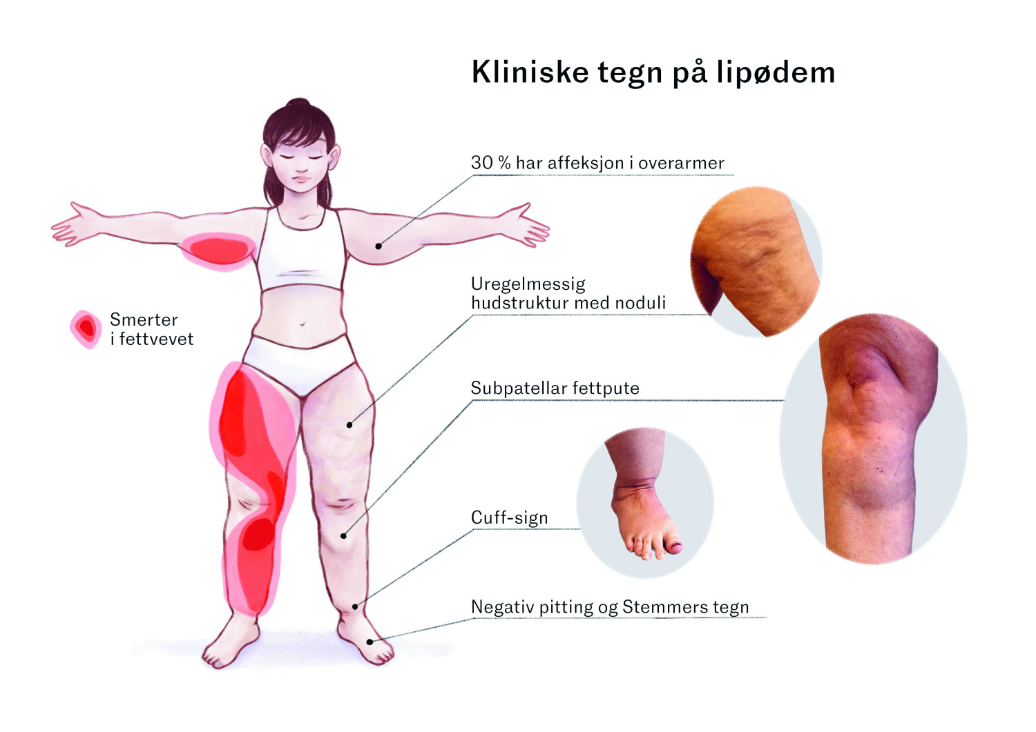 Figur 1 Kliniske tegn p&aring; lip&oslash;dem. Illustrasjonen viser karakteristisk fettfordeling og kroppsfasong ved lip&oslash;dem (2, 6)&hellip;