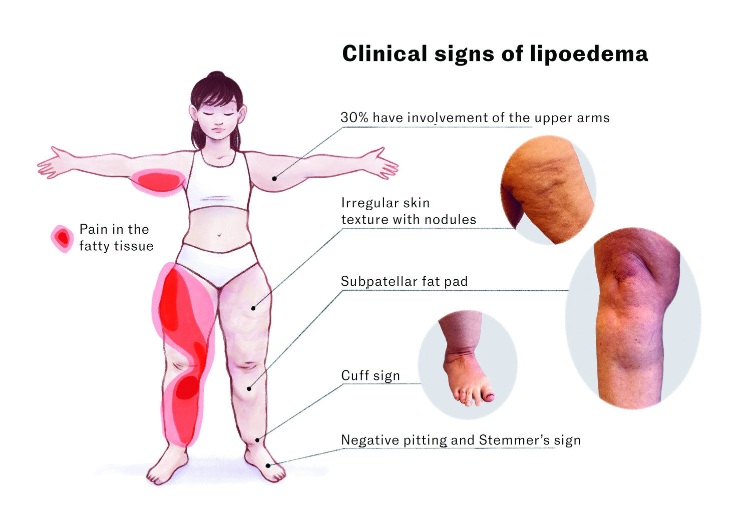 Figure 1 Clinical signs of lipoedema. The illustration shows the characteristic fat distribution and body shape seen in&hellip;