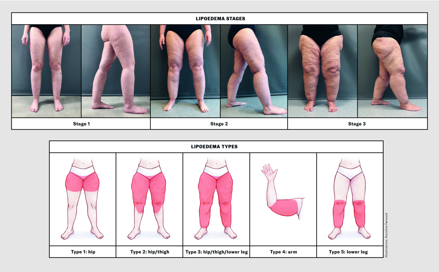 Figure 2 Lipoedema stages and types. The images in Figure 2a show changes in the skin surface and the texture of the&hellip;