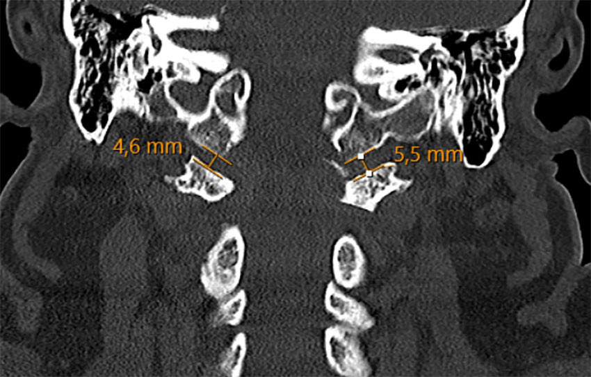 Figur 1 CT-unders&oslash;kelse av nakken viste &oslash;kt leddspalte i atlanto-oksipitalleddene, m&aring;lt til 5,5&nbsp;mm p&aring; h&oslash;yre side og 4,6&nbsp;mm&hellip;