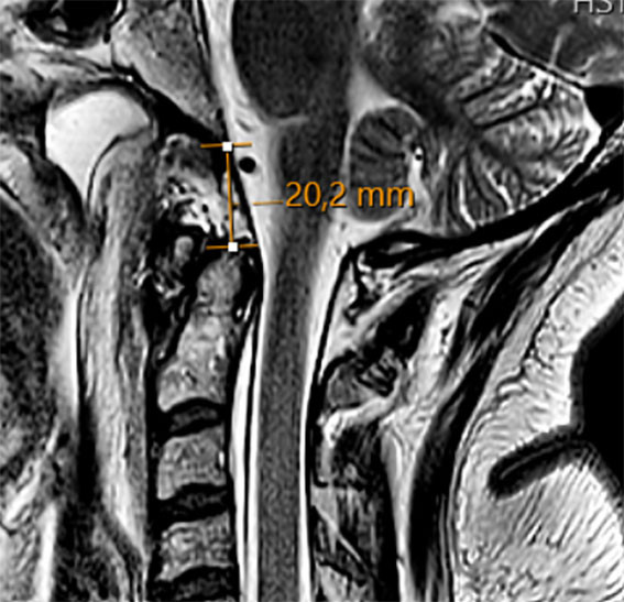 Figur 2 Unders&oslash;kelse med T1-vektet MR viste &oslash;kt avstand i basion-dens-intervallet (BDI) p&aring; 20,2&nbsp;mm (normal avstand < 8,5&nbsp;mm).