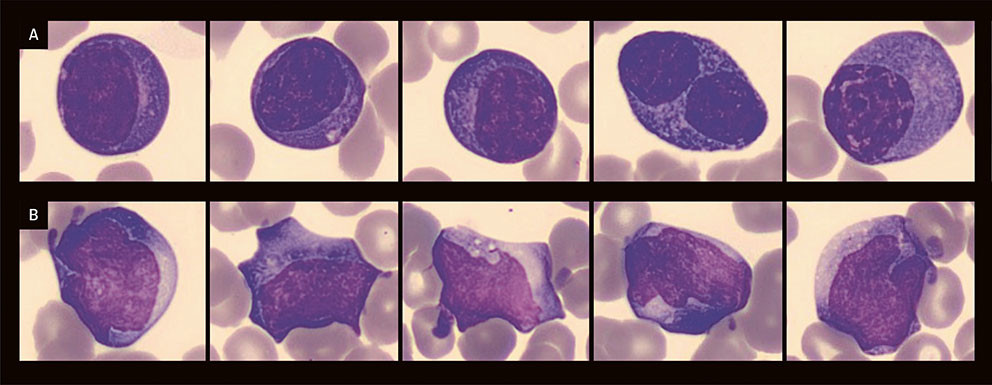 Figur 1 Eksempler p&aring; plasmaceller (a) og reaktive lymfocytter (b) i perifert blodutstryk fra pasienten.