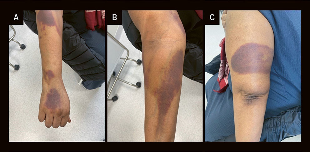 Figur 2 Kutane bl&oslash;dninger