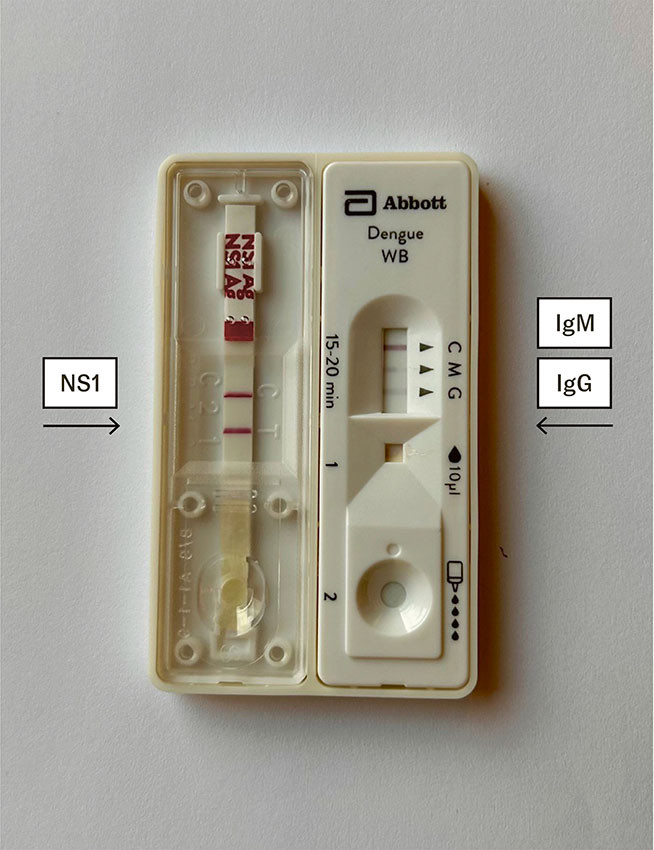 Figur 4 Positiv immunkromatografisk hurtigtest for virusantigen (NS1), IgM og IgG hos pasienten.