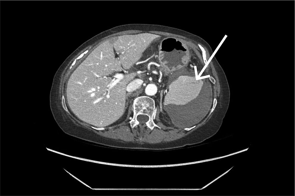 Figure 1 An emergency CT scan performed on admission shows a subcapsular splenic haematoma with varying fluid density. The&hellip;