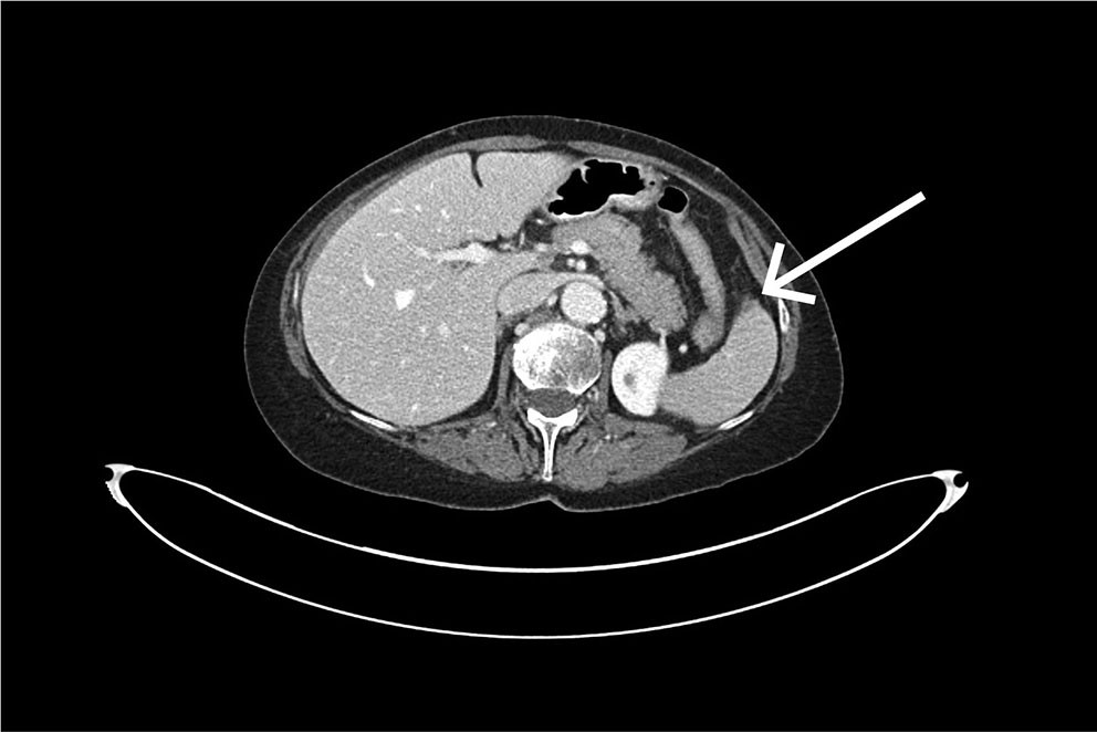 Figure 2 On closer inspection of the CT scan taken shortly after the colonoscopy, a small subcapsular laceration (in the&hellip;