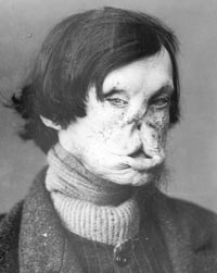 Han ble ogs&aring; talt: Nils S&aelig;tre (1832&thinsp;&ndash;&thinsp;85), pasient p&aring; Pleiestiftelsen fra 1857. Lidelsen f&aring;r et ansikt for oss &ndash; men vi kan&hellip;