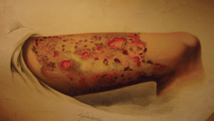 Et bein med radesyke, tegnet 80 &aring;r etter at pasientene Heivoll skriver om, ble sendt til K&oslash;benhavn. P&aring; denne tiden ble&hellip;