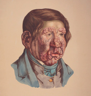 &laquo;En 13 Aar gammel Dreng, hos hvem Knuderne ere fuldkommen udviklede, de ere confluerede paa flere Steder, og mange have&hellip;