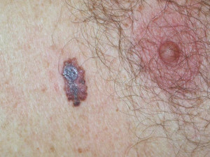 Figur 1 Superfisielt melanom