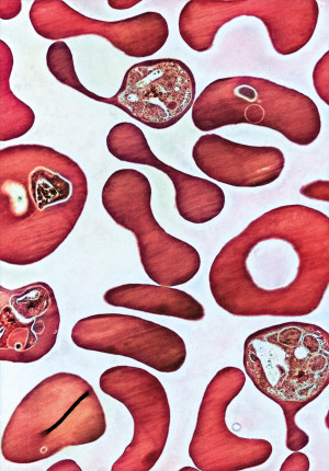 R&oslash;de blodceller infisert med malariaparasitter. Illustrasjonsfoto: Science Photo Library/NTB scanpix