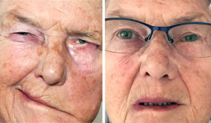 Figur 1 F&oslash;r og etter operasjon. Dame i 60-&aring;rene med venstresidig komplett facialisparese som har f&aring;tt utf&oslash;rt statisk&hellip;