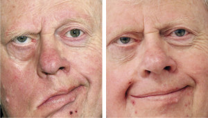 Figur 2 F&oslash;r og etter operasjon. Mann i 60-&aring;rene med komplett venstresidig facialisparese som har f&aring;tt utf&oslash;rt dynamisk&hellip;