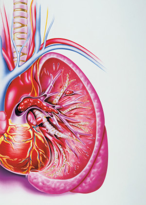 Lungeembolisme med en stor embolus som blokkerer lungearterien til venstre og en mindre embolus i en arterie ovenfor til&hellip;