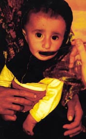  Figur 4    Livreddende drikke: rehydreringssalter (Iran 1991)