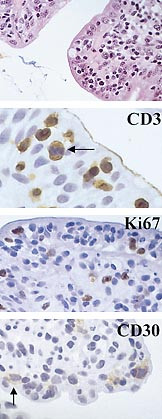 Figur 3   Immunhistokjemiske analyser av celler og vev var forskning for 15 &ndash; 20 &aring;r siden, men er n&aring; en del av hverdagen i&hellip;