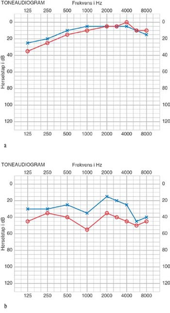 Figur 2   a) Audiogram fra oktober 1998 viser n&aelig;rmest symmetrisk og god h&oslash;rsel p&aring; begge &oslash;rer.  b) Audiogram fra juni 2001&hellip;