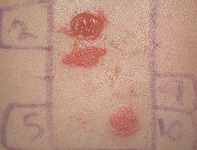 Figure 2  Positive patch test with erythema, vesicles and bullae