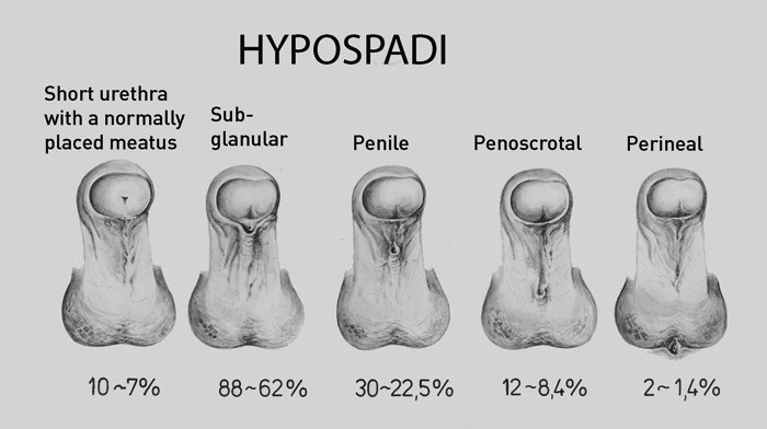 Figure 2  Hypospadias types &ndash; percentual distribution (12). Reproduced with permission
