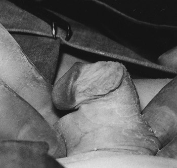 Figure 3  Ventral curvature of penis (chorda) (12). Reproduced with permission