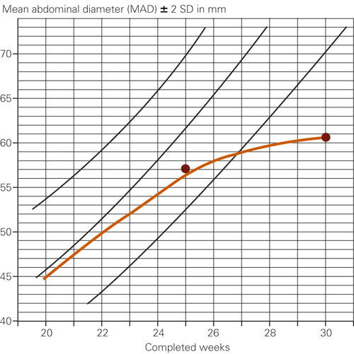 Figure 2  The foetus&rsquo; abdominal growth in relation to gestational age