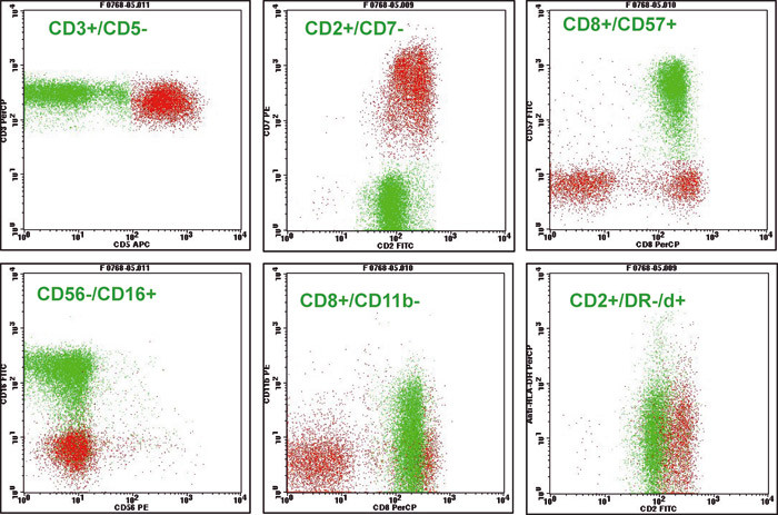 Figure 2  A flow cytometric examination of lymphocytes in blood in patients with LGL- leukaemia. The clonal T-cell&hellip;