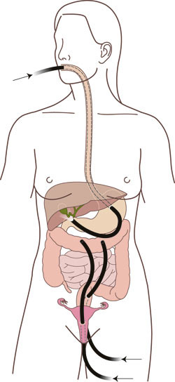 Forskjellige tilganger ved kropps&aring;pningsbasert transluminal kirurgi, flere kan kombineres