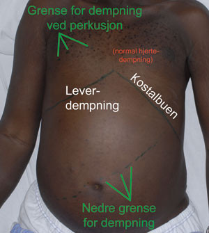 Figur 2  Pasient med en stor leversvulst. Bildet illustrerer hvor man fant dempning ved perkusjon og er et eksempel p&aring;&hellip;