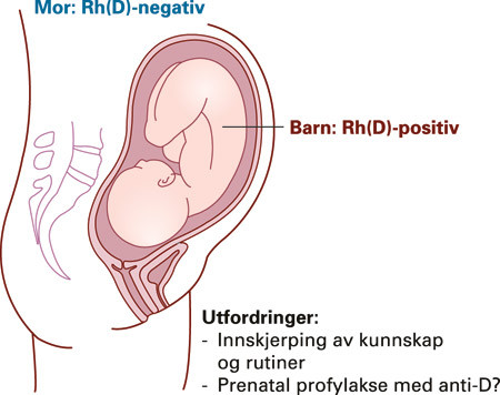 Figur 2  Rh(D)-negativ mor kan immuniseres mot antigenet Rh(D) p&aring; fosterets erytrocytter