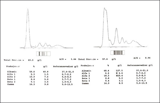 Figur 2  Til venstre ser man normalt serum hos pasient 1 (fra gelen i fig 1), til h&oslash;yre serum fra pasient 10 med&hellip;