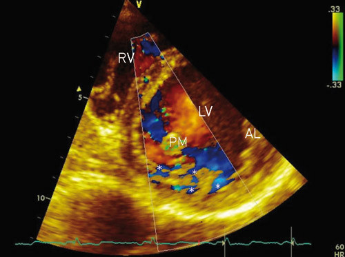 Figure 2.  Transthoracic echocardiography, parasternal short axis view of the LV. Colour Doppler of blood flow in the LV&hellip;