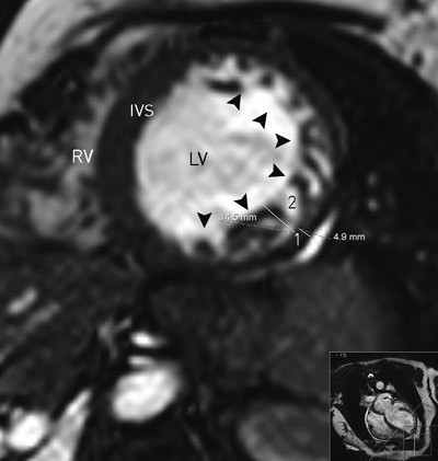 Figure 3.  Magnetic resonance tomography of the heart. End-diastolic short axis view of the LV and RV. The lateral wall and&hellip;