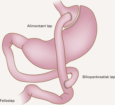 Teknisk utf&oslash;relse av fedmeoperasjon med laparaskopisk Roux-en Y gastrisk bypass (LRYGBP)