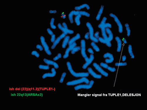 Figur 2  FISH-analyse som viser en delesjon av et omr&aring;de p&aring; kromosom 22 forbundet med DiGeorges syndrom. Delesjonen&hellip;