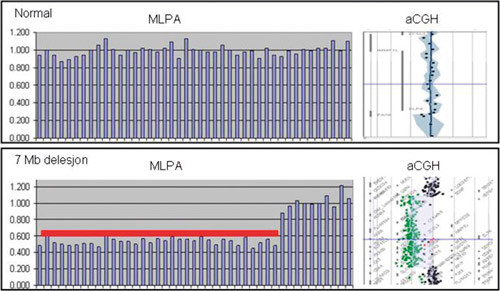Figur 3  En sammenlikning av resultater fra MLPA-analyse (multipleks ligeringsavhengig probeamplifikasjon) og aCGH-analyse &hellip;