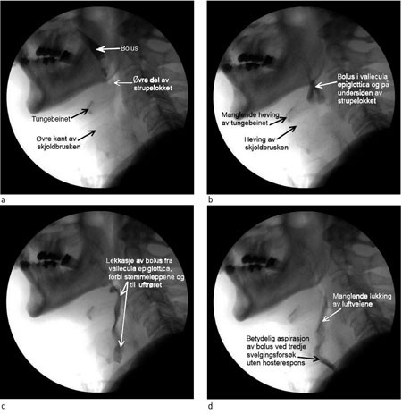Figur 1  Bilder fra videofluoroskopiopptak av kreftpasient etter str&aring;lebehandling. Bildene (a&thinsp;&ndash;&thinsp;d) viser orofaryngeale&hellip;
