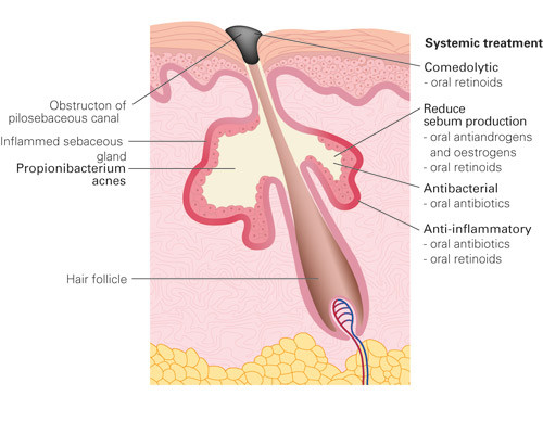 Figure 1  Anatomy of sebaceous gland and points of attack of various medicinal products